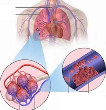 Ảnh 2 của Thuyên tắc động mạch phổi